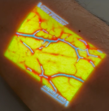 veinfinder brazo visualiza vasos sanguineos